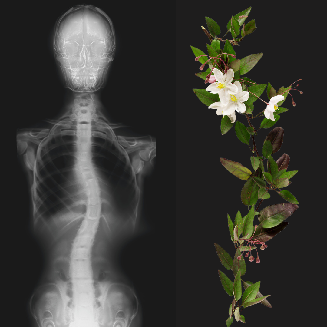 two sided image with an xray of a scoliosis spine on the left and a curved flower vine on the right